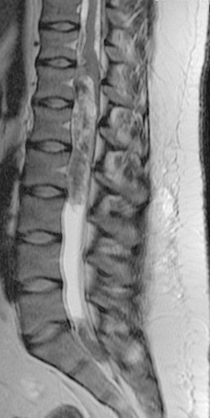 Guzy kanału kręgowego